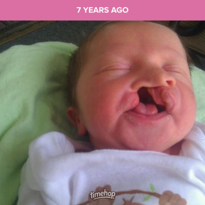 Newborn baby with a cleft palette