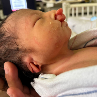 Newborn baby with cleft palette